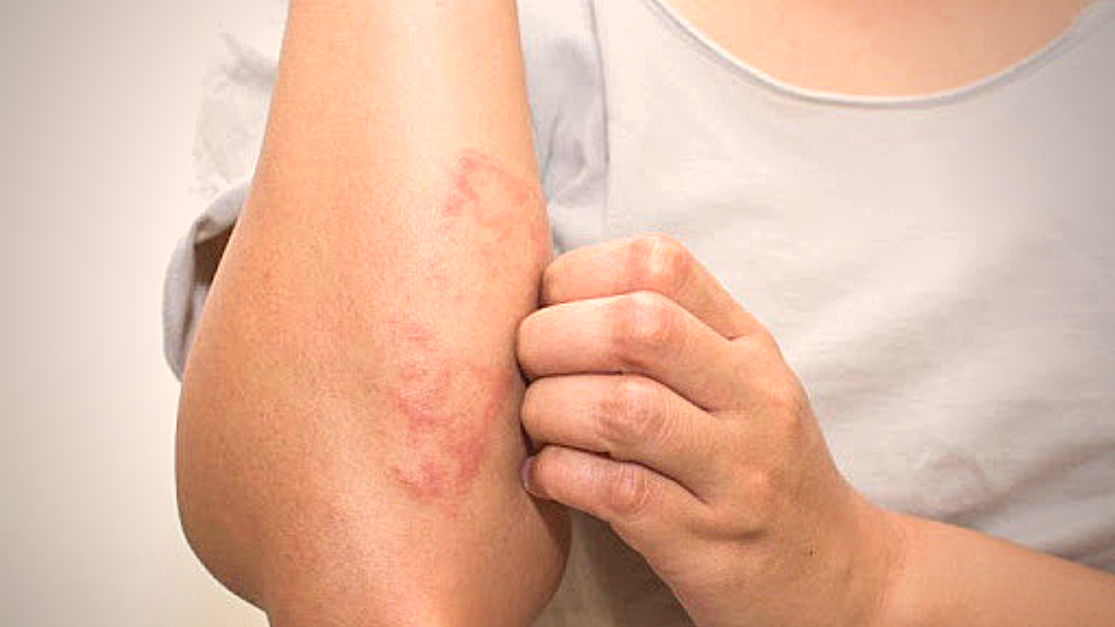 DÍA MUNDIAL CONTRA LA LEPRA: ¿De dónde viene la enfermedad y cuántos casos hay en Argentina?