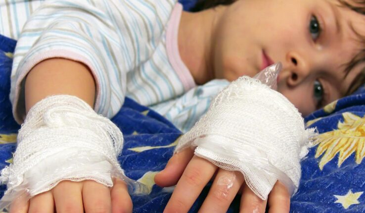 quemadura hospitales