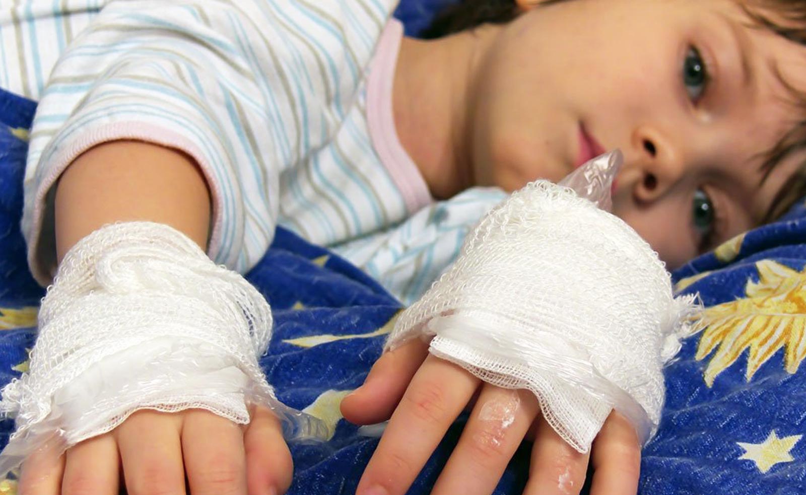 ¿Qué hacer y dónde acudir en caso de una quemadura por pirotecnia?