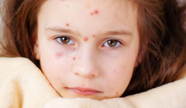 Viruela del mono y polio
