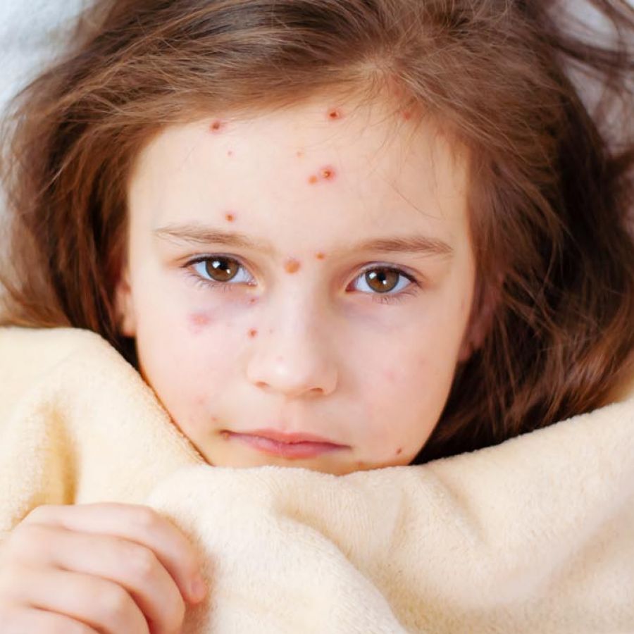 Viruela del mono y polio