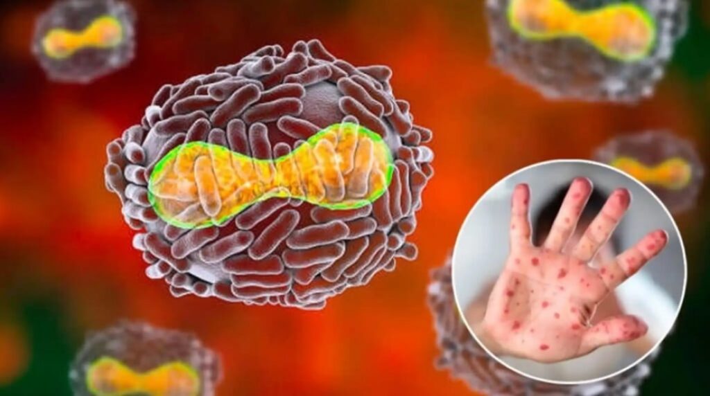 aumento nuevos casos viruela mono Argentina