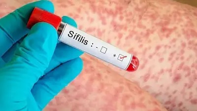 Sífilis récord en Argentina: los casos siguen en aumento 